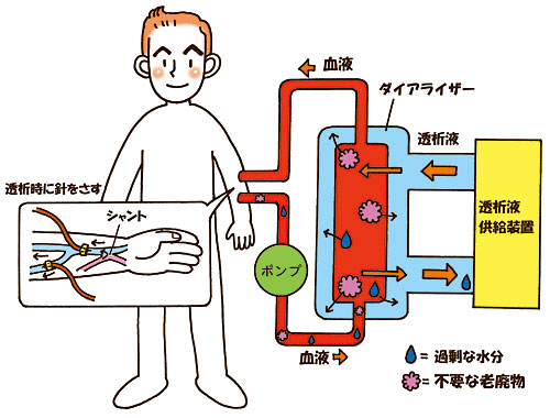 透析図